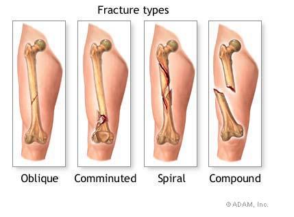 Fracture types.JPG